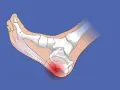 Ilustración de la anatomía del pie, mostrando la inflamación en el talón, indicando tendinitis por mal calzado.