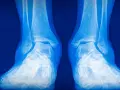 Radiografía de tobillos y pies. La imagen muestra la anatomía ósea, útil para evaluar condiciones como el pie valgo y la elección de zapatos adecuados.
