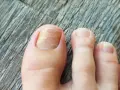 Primer plano de un pie con una uña amarilla, mostrando la textura y el color alterado.