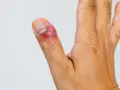 Dedo pulgar con inflamación y enrojecimiento alrededor de la uña, indicando un dedo infectado. La piel está irritada.