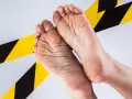 Pies agrietados y secos, señal de trabajar 8 horas de pie. Cinta de advertencia amarilla y negra rodea los pies.