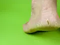 Talón con grietas profundas, mostrando la necesidad de saber como curar grietas profundas en los pies para aliviar el dolor y la sequedad.