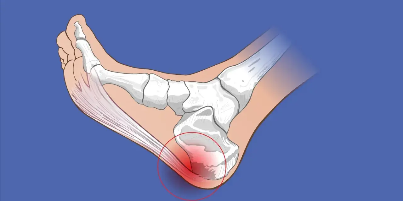 Ilustración de la anatomía del pie, mostrando la inflamación en el talón, indicando tendinitis por mal calzado.