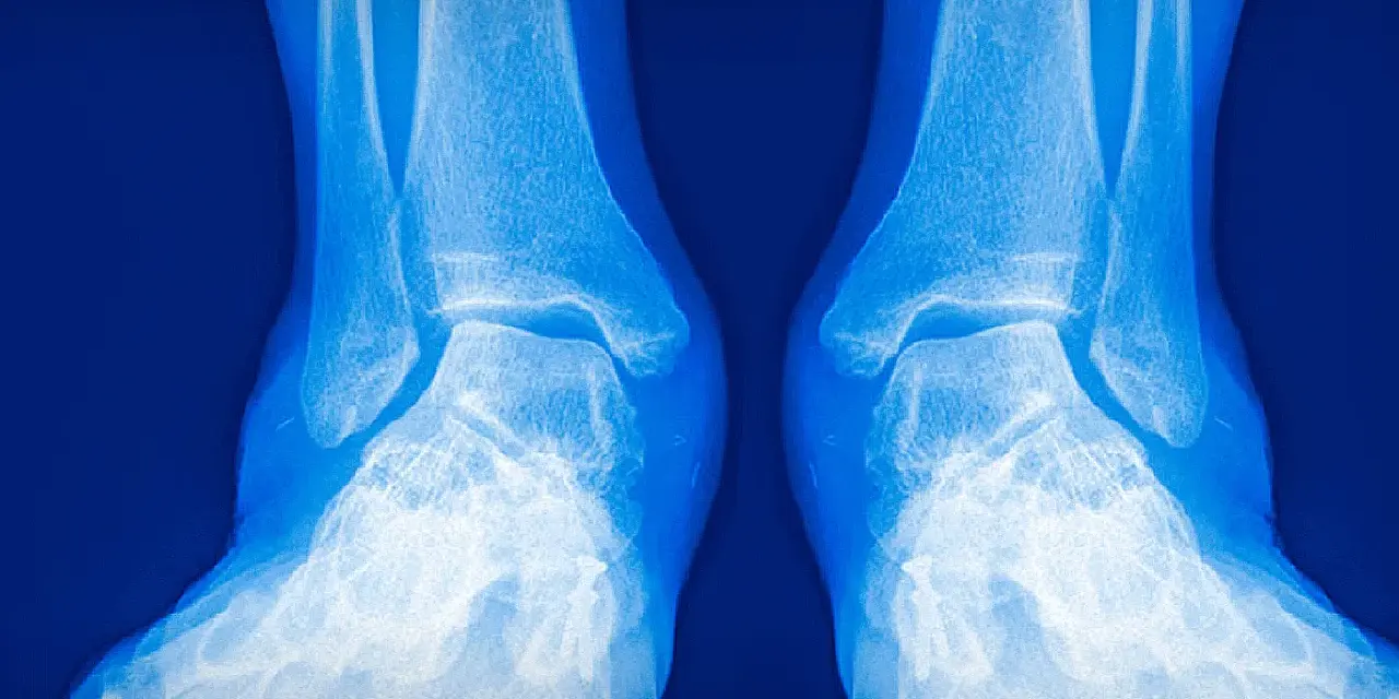 Radiografía de tobillos y pies. La imagen muestra la anatomía ósea, útil para evaluar condiciones como el pie valgo y la elección de zapatos adecuados.