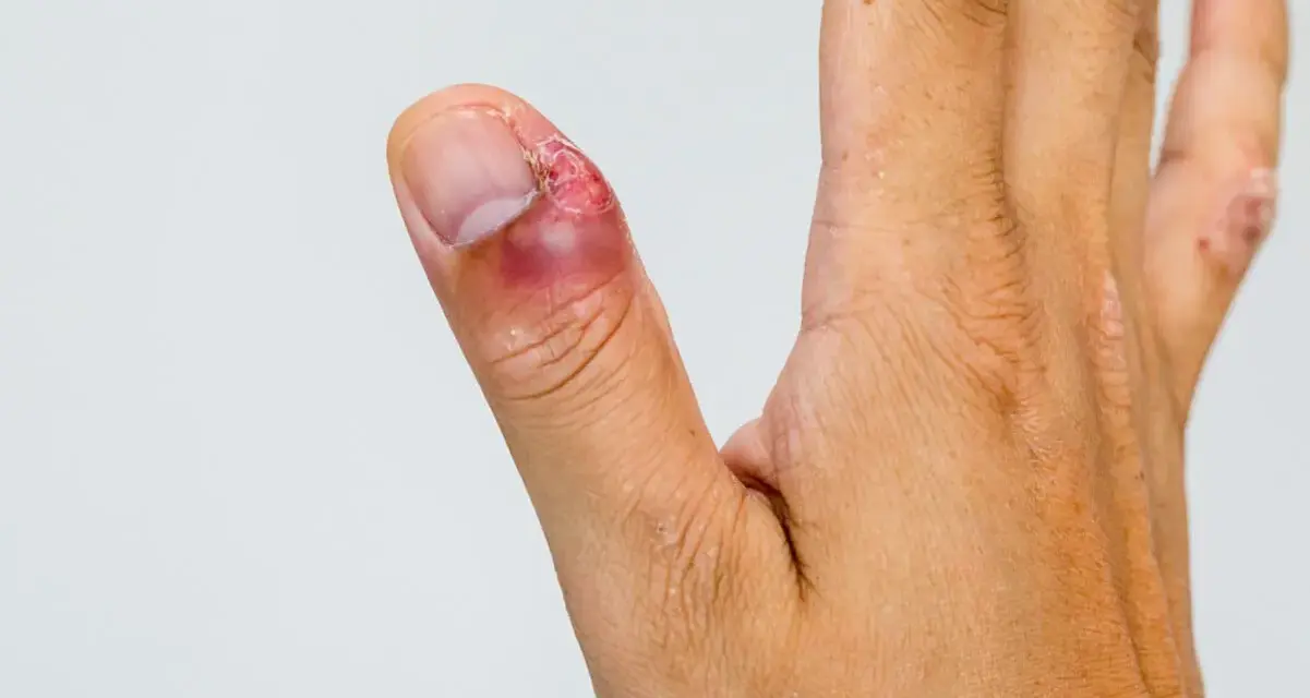 Dedo pulgar con inflamación y enrojecimiento alrededor de la uña, indicando un dedo infectado. La piel está irritada.