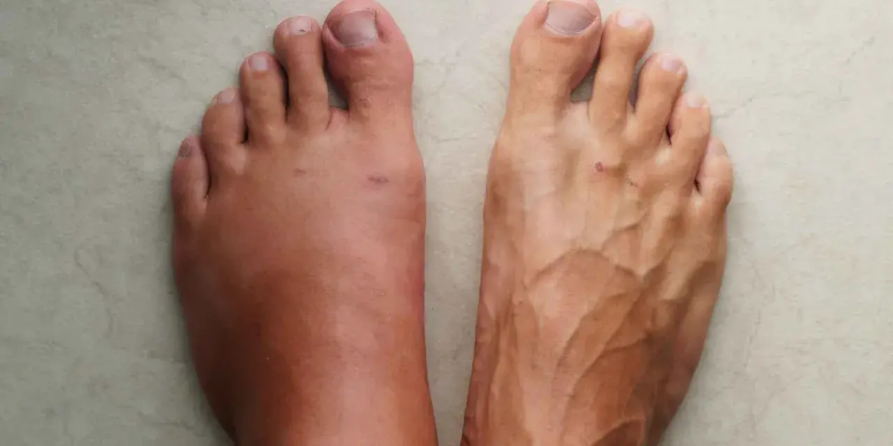 Pies comparados: uno hinchado por retención de líquidos, el otro con venas marcadas.
