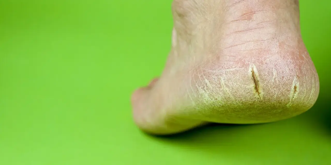 Talón con grietas profundas, mostrando la necesidad de saber como curar grietas profundas en los pies para aliviar el dolor y la sequedad.