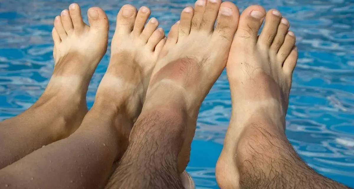 Pies bronceados con líneas blancas, indicando problemas de pie griego por el sol.