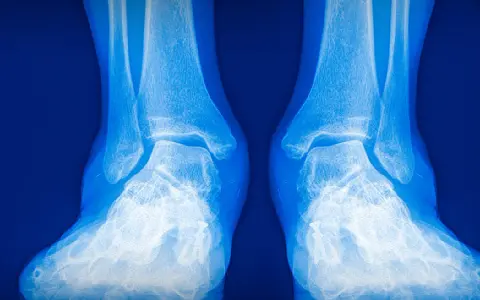 Radiografía de tobillos y pies. La imagen muestra la anatomía ósea, útil para evaluar condiciones como el pie valgo y la elección de zapatos adecuados.