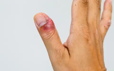 Dedo pulgar con inflamación y enrojecimiento alrededor de la uña, indicando un dedo infectado. La piel está irritada.