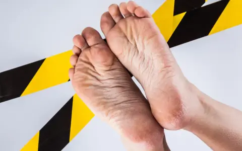 Pies agrietados y secos, señal de trabajar 8 horas de pie. Cinta de advertencia amarilla y negra rodea los pies.