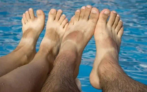 Pies bronceados con líneas blancas, indicando problemas de pie griego por el sol.