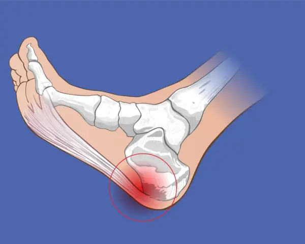 Ilustración de la anatomía del pie, mostrando la inflamación en el talón, indicando tendinitis por mal calzado.