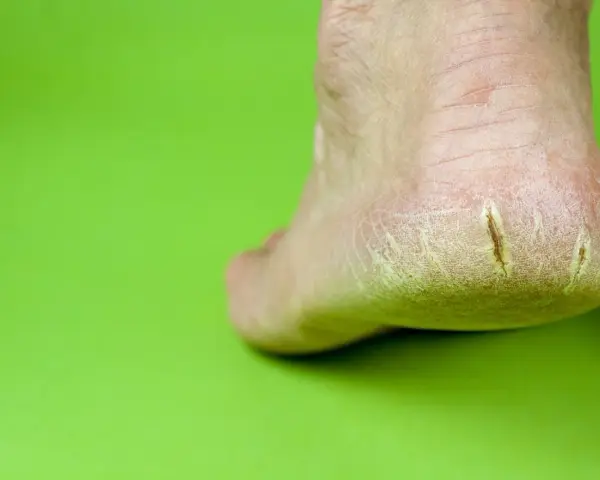 Talón con grietas profundas, mostrando la necesidad de saber como curar grietas profundas en los pies para aliviar el dolor y la sequedad.