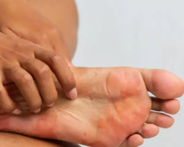 Una persona se rasca el pie, mostrando enrojecimiento e irritación. ¿Cómo saber si tengo hongos en los pies?