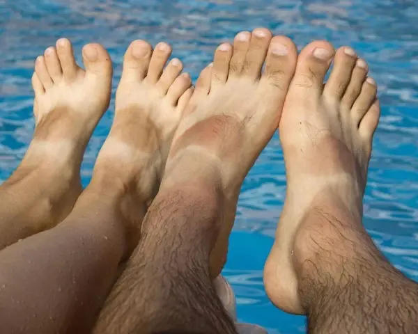 Pies bronceados con líneas blancas, indicando problemas de pie griego por el sol.