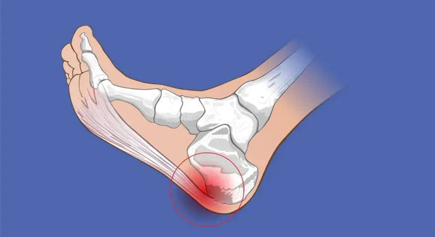 Ilustración de la anatomía del pie, mostrando la inflamación en el talón, indicando tendinitis por mal calzado.