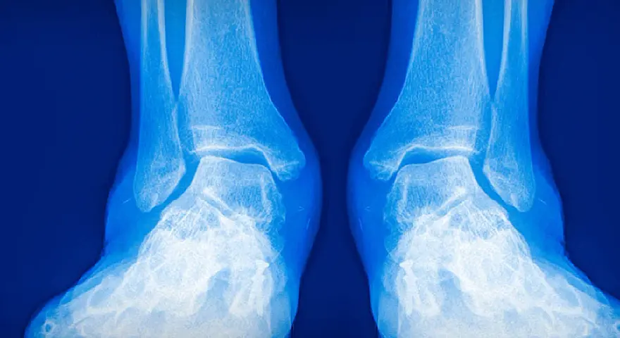 Radiografía de tobillos y pies. La imagen muestra la anatomía ósea, útil para evaluar condiciones como el pie valgo y la elección de zapatos adecuados.