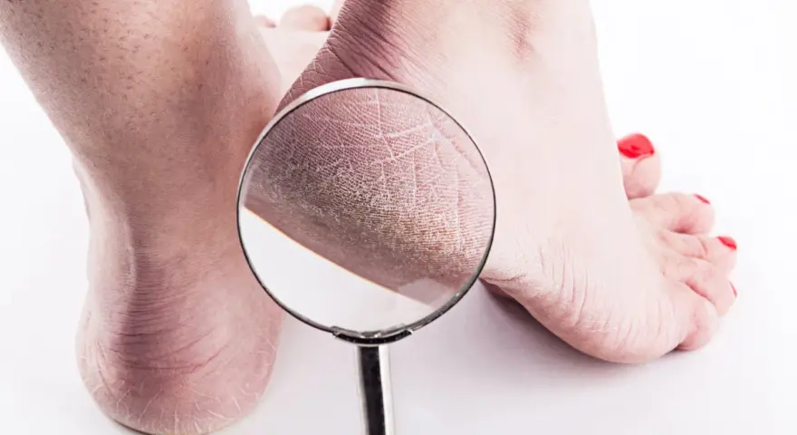 Pies agrietados y secos, con una lupa mostrando la textura de la piel. Podrían ser síntomas de hongos.