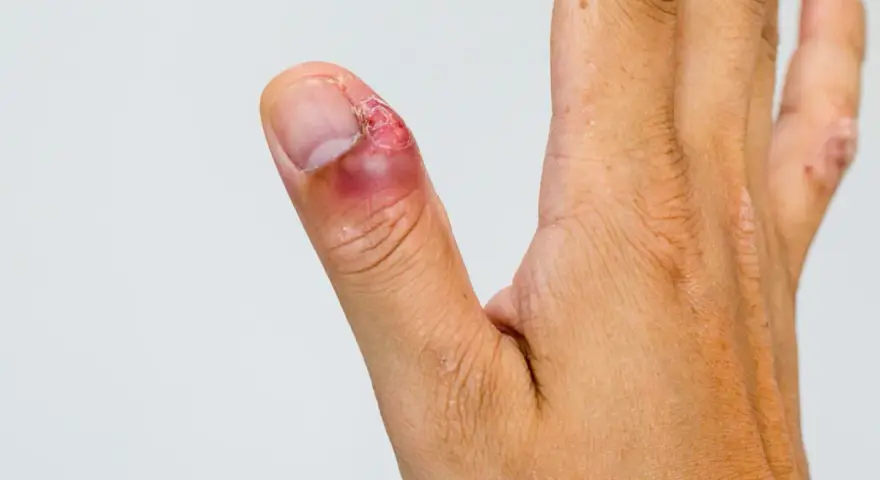 Dedo pulgar con inflamación y enrojecimiento alrededor de la uña, indicando un dedo infectado. La piel está irritada.