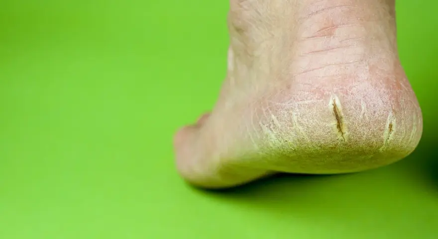 Talón con grietas profundas, mostrando la necesidad de saber como curar grietas profundas en los pies para aliviar el dolor y la sequedad.