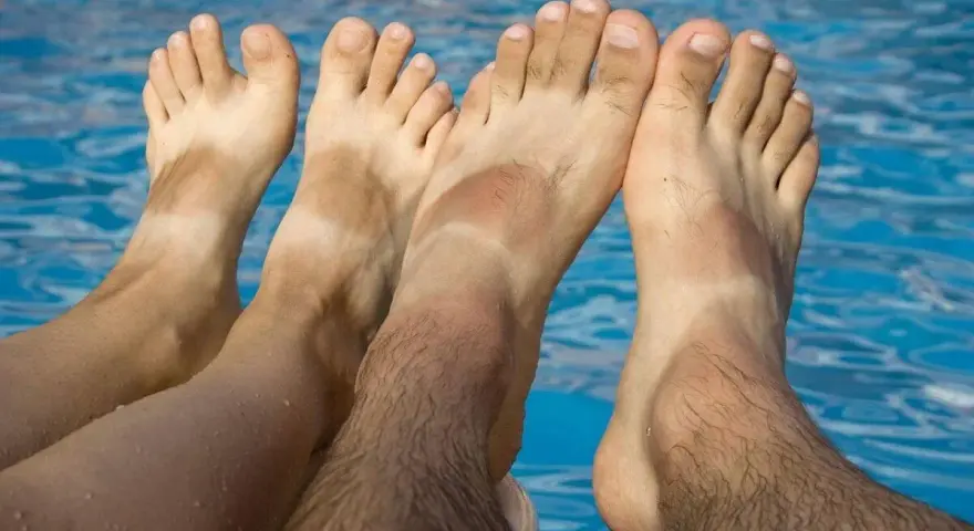 Pies bronceados con líneas blancas, indicando problemas de pie griego por el sol.