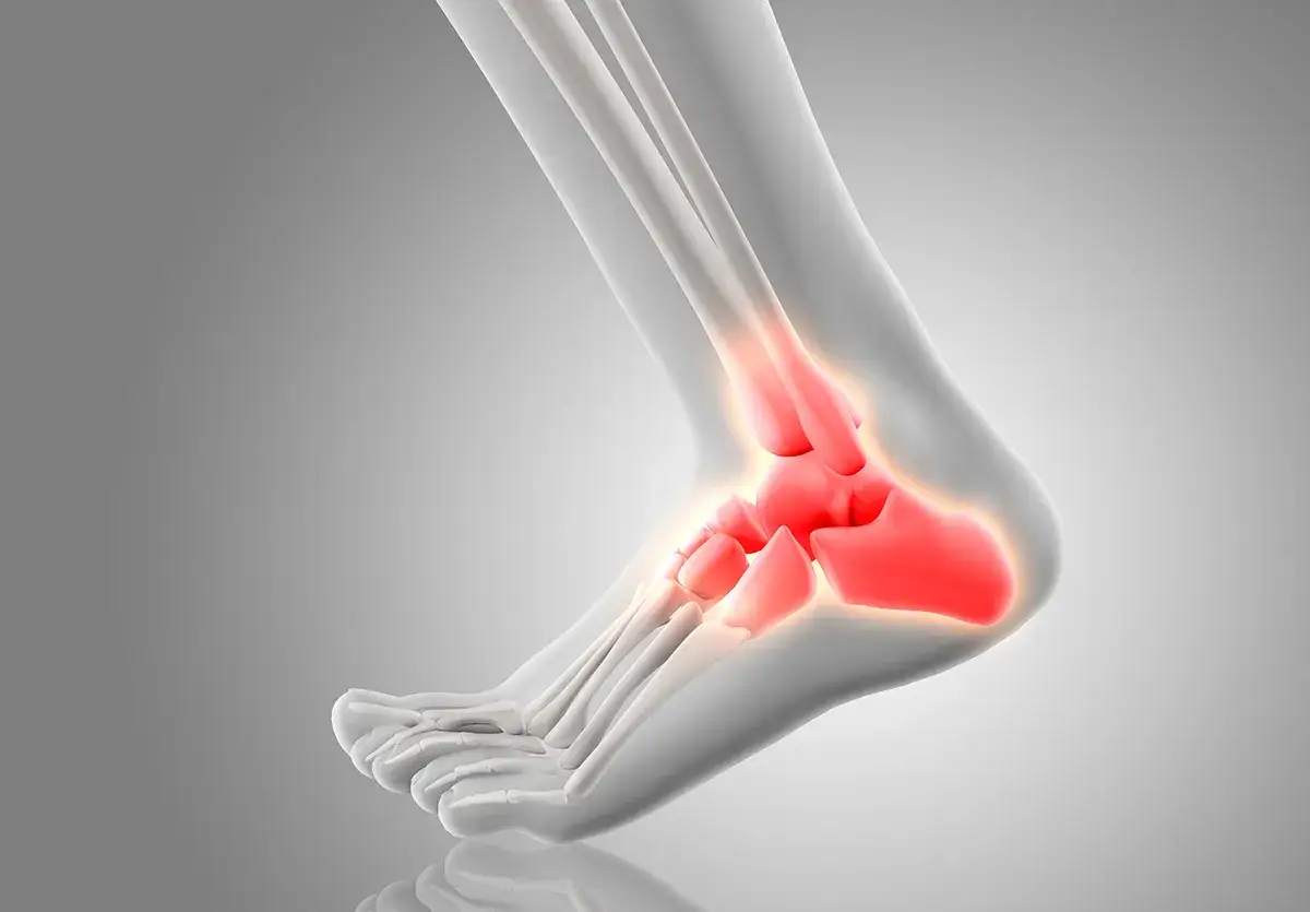 Ilustración 3D de un tobillo con tendinitis por mal calzado. Las áreas en rojo indican inflamación en los huesos del talón y el tobillo.