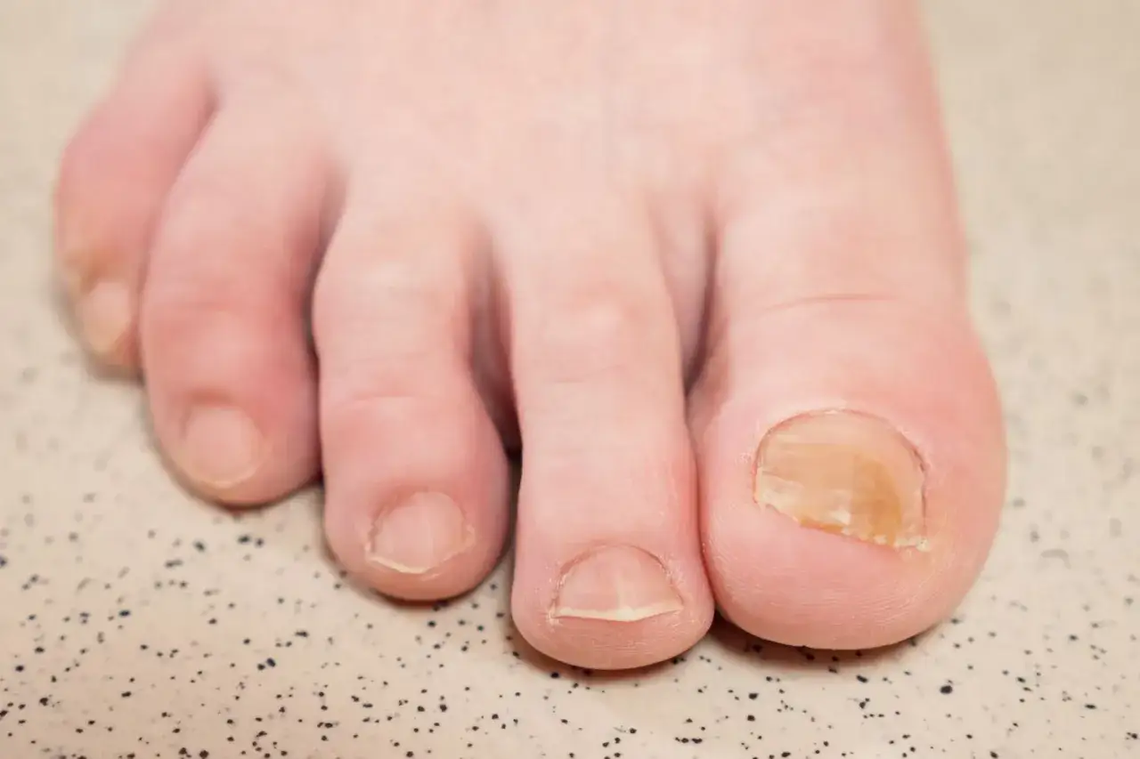Primer plano de un pie con los dedos de los pies. La uña del dedo gordo del pie es amarilla y parece tener una infección fúngica.